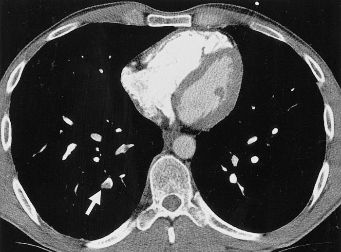 An example a CT scan of several, smaller embolisms in the lungs, much like my example.