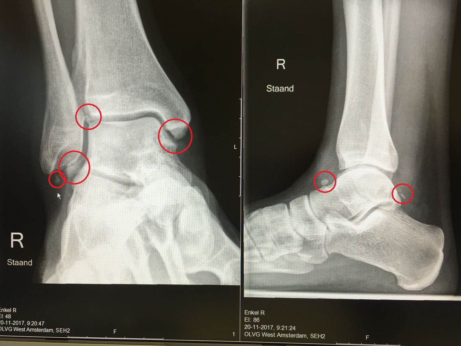 bilateral ankle swelling icd 10